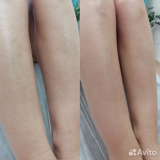 Депиляция/шугаринг