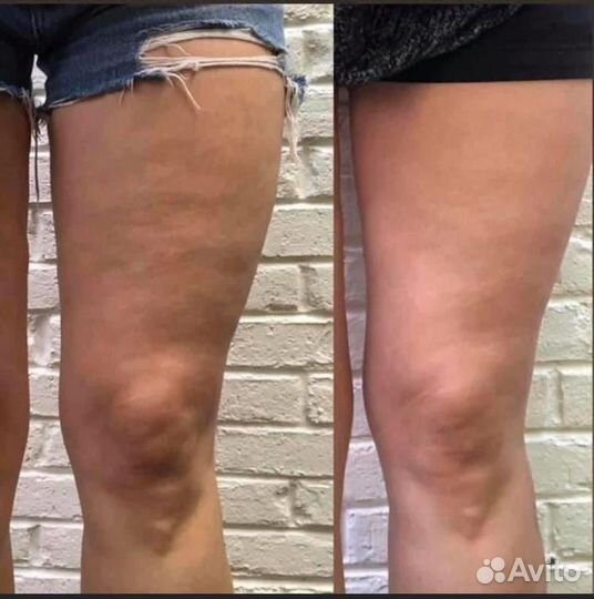 Экспресс коррекция фигуры LPG, кавитация, вакуум