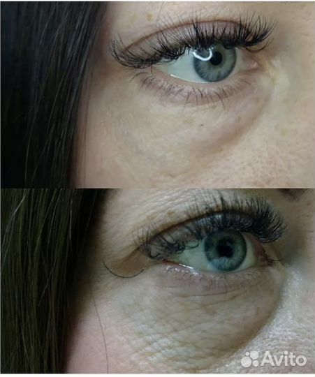 Подтяжка кожи верхнего и нижнего века