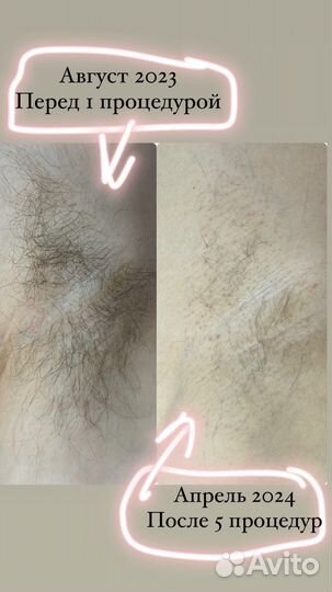 Электроэпиляция