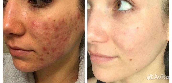 Лазерное лечение акне