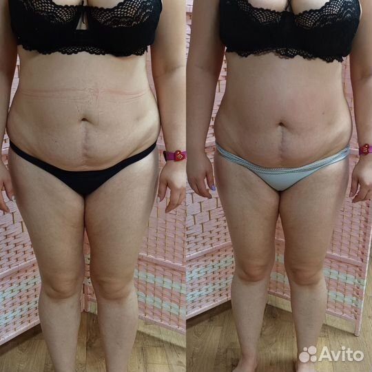 Вибро,вакуумный,вакуумно роликовый массаж