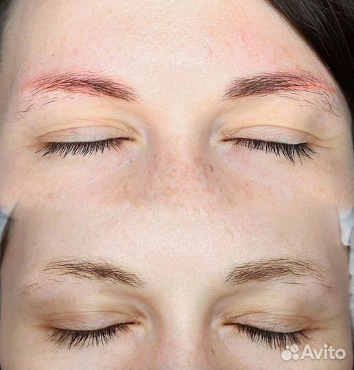 Удаление тату/татуажа