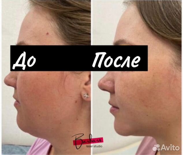 LPG массаж, аппаратный массаж, кавитация