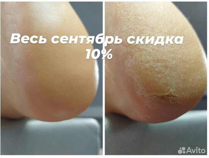 Педикюр(работа со сложной стопой)