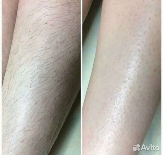 Шугаринг/ Ваксинг