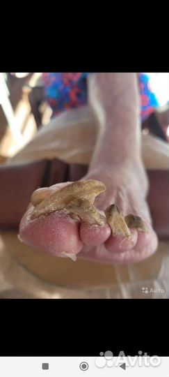 Медицинский педикюр аппаратный. Выезд на дому