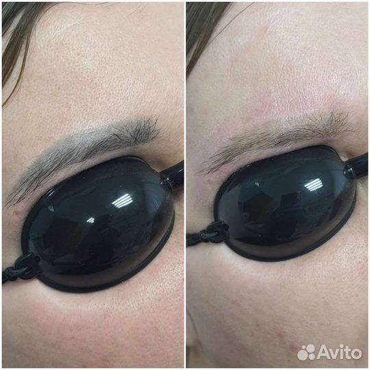 Лазерное удаление татуажа/тату