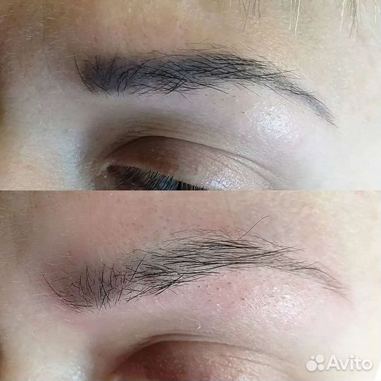 Удаление тату/татуажа