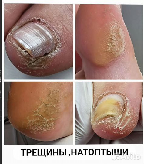 Педикюр на дому