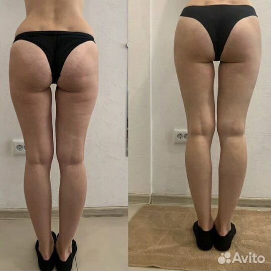 Аппаратная коррекция фигуры