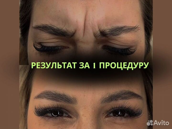 Ботокс для лица ботулотоксин косметолог