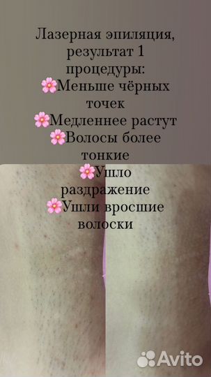 Лазерная эпиляция