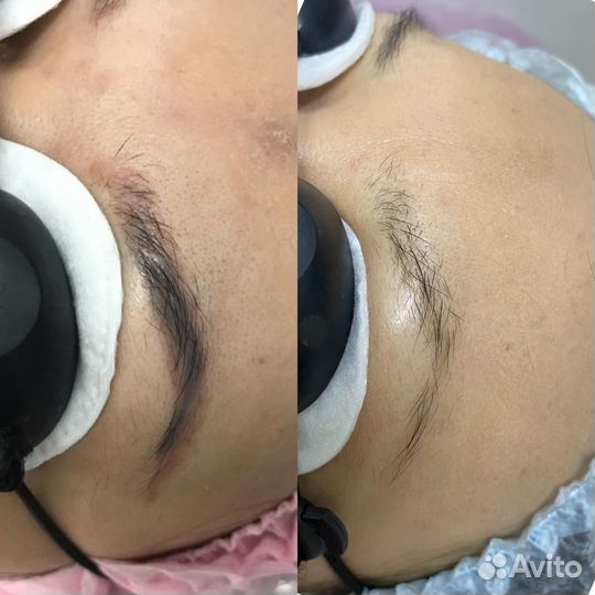 Удаление татуажа и тату лазером