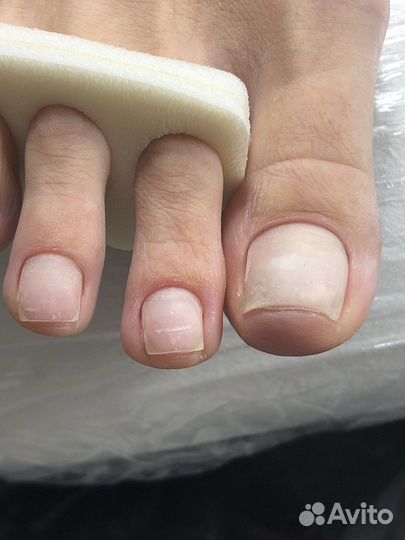 Подолог.Вросший ноготь