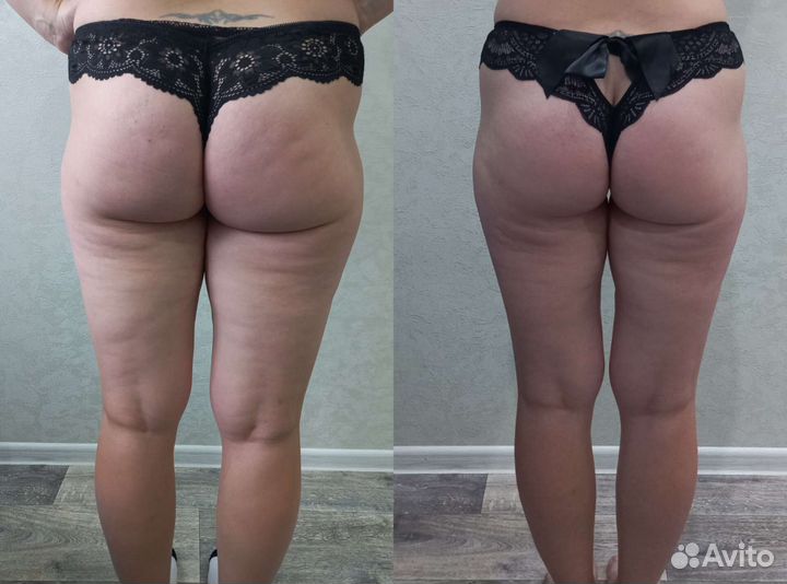 Антицеллюлитный массаж, аппаратный массаж. Южный