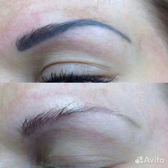 Удаление тату/татуажа