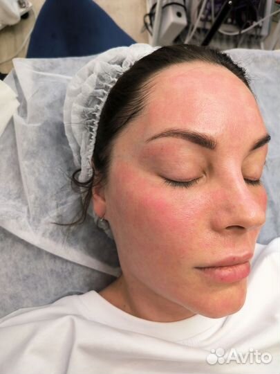 РФ лифтинг лица