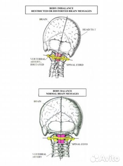 Коррекция первого шейного позвонка атланта