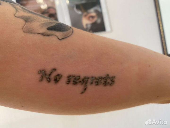 Удаление татуировок, татуажа