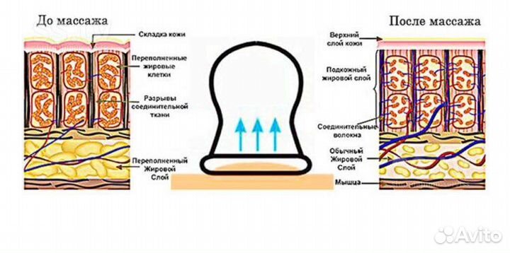 Аппарат для вакуумного массажа