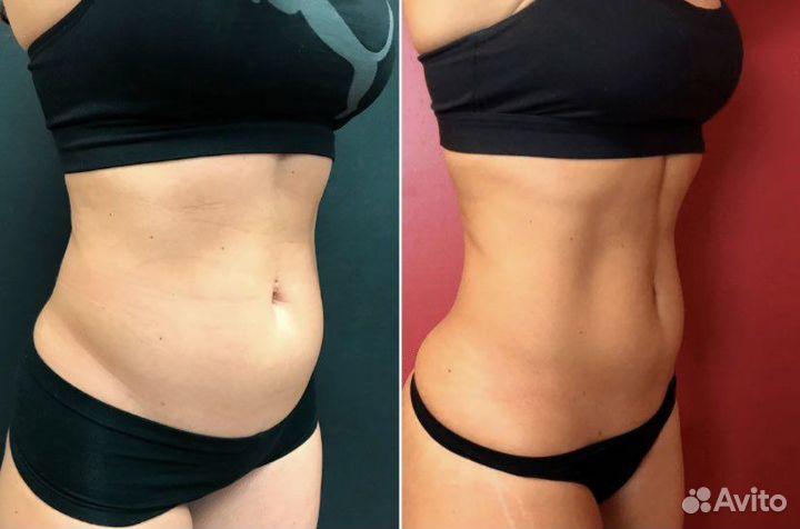 Emsculpt прокачка мышц и жиросжигание