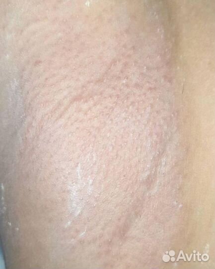 Восковая эпиляция