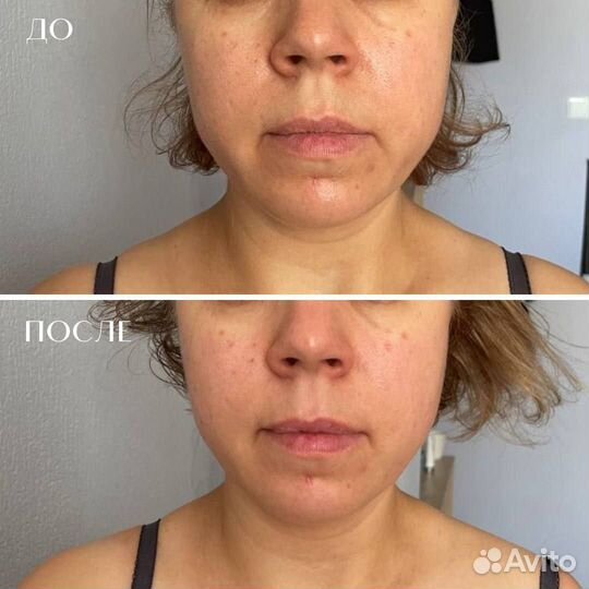 Скульптурный массаж лица