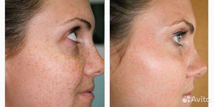 Убрать пигментные пятна, отбелить лицо даже летом