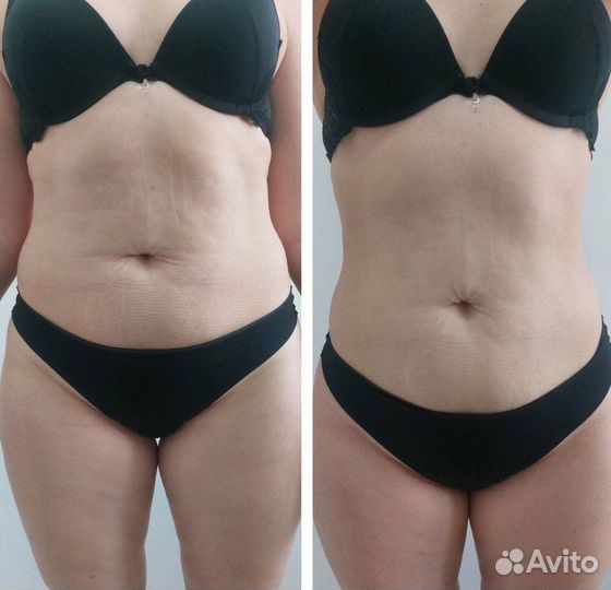 Стройная фигура - Аппаратная коррекция фигуры