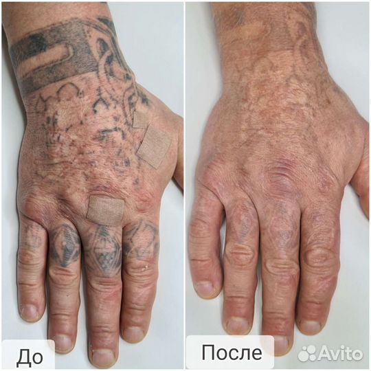 Удаление тату и татуажа
