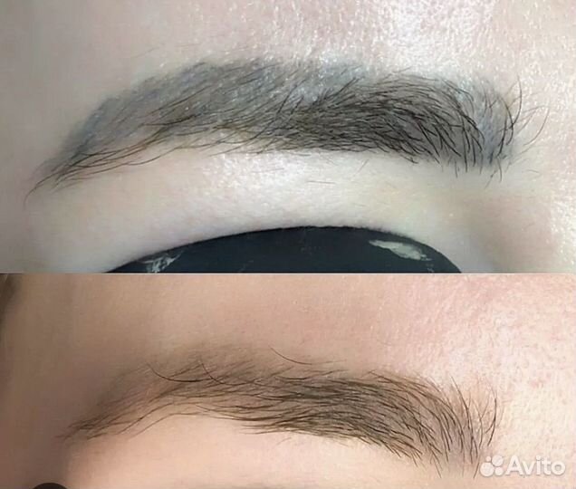 Удаление татуажа бровей лазером