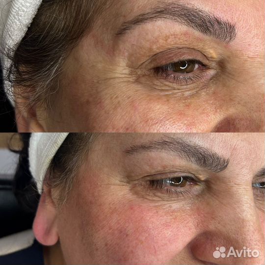 Уколы красоты