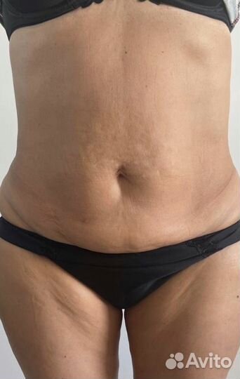 Микроигольчатый РФ