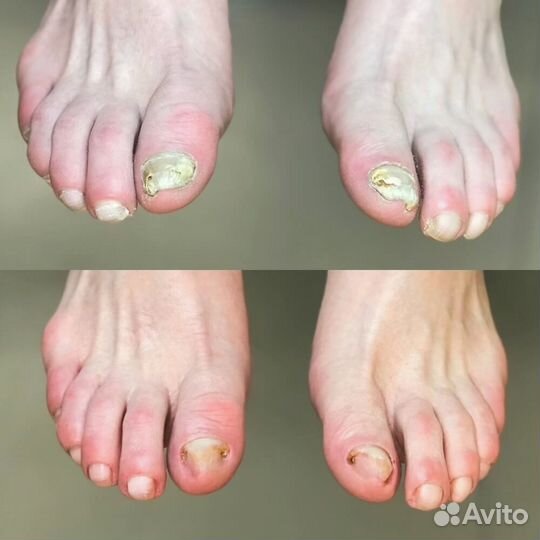 Услуги подолога, вросший ноготь