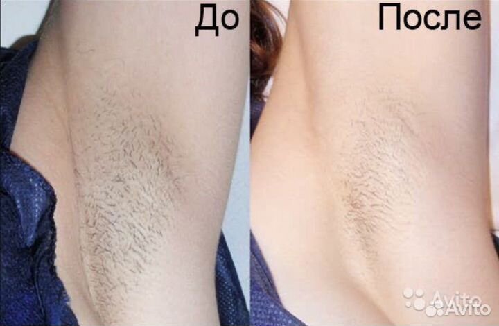 Удаление татуажа, тату, пилинг, лазерная эпиляция