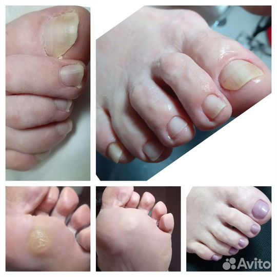 Подолог, выезд на дом(Мед.педикюр)шугар. депиляция