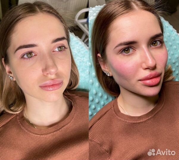 Лицо под ключ Full Face гармонизация обучение