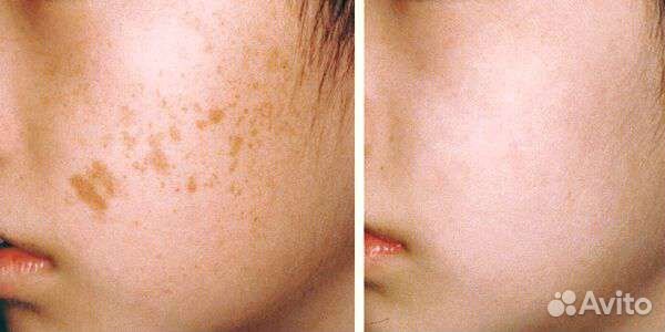 Убрать пигментные пятна, отбелить лицо даже летом