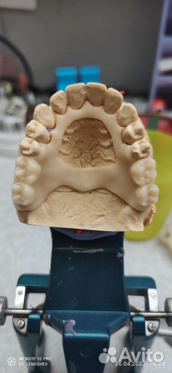 3d моделирование каркасов бюгельных протезов