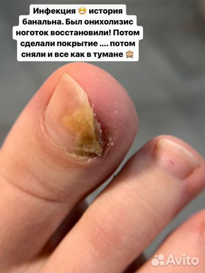 Подолог,трещины,вросший,бородавки,мозоли,микоз