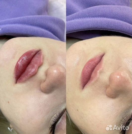 Модель на увеличение губ