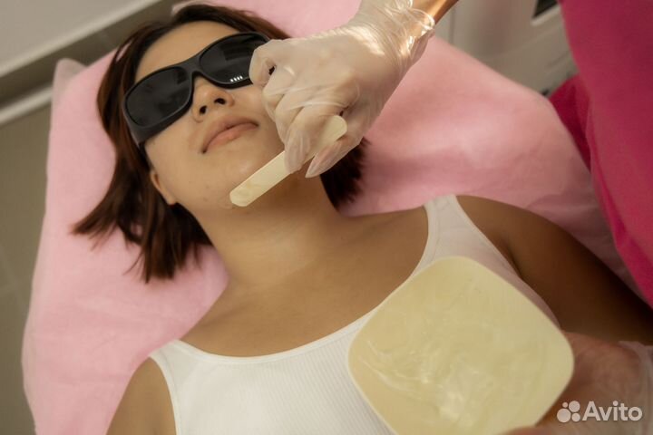 Лазерная эпиляция