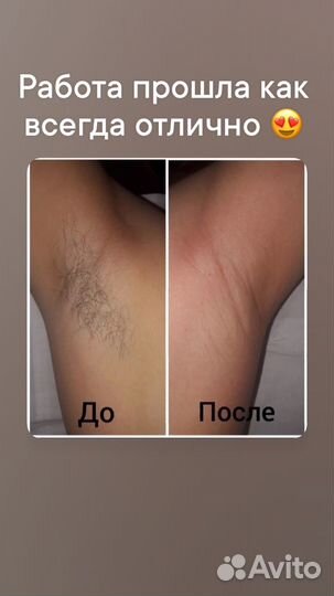 Шугаринг(депиляция)