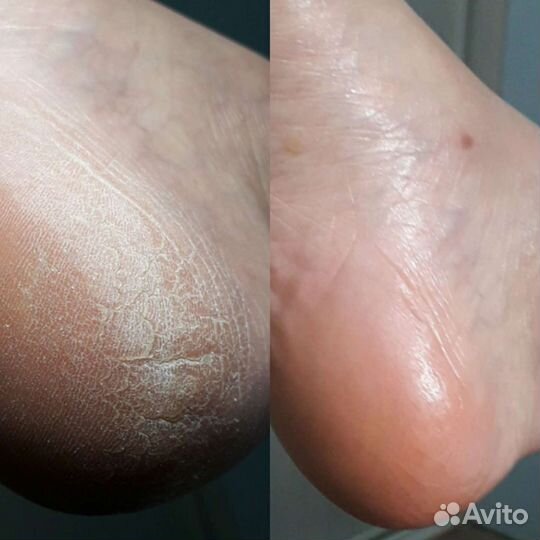 Аппаратный педикюр