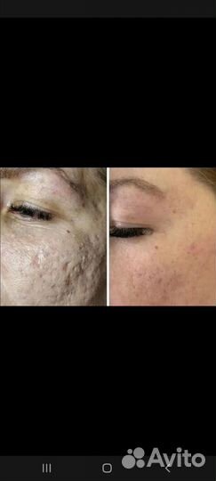 Сосуды.Шрамы.Рястяжки+Подтяжка