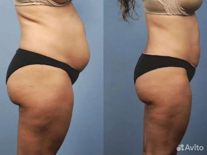 Набираю моделей на курс похудения