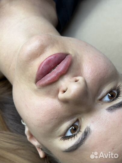 Увеличение губ, ботокс, липолитики, углы