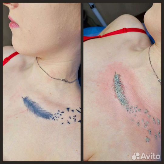 Удаление Татуировок Татуажа