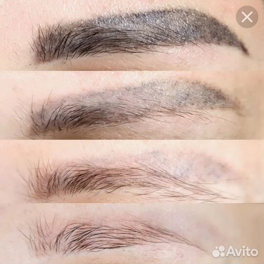 Лазерное удаление тату, татуажа бровей, губ